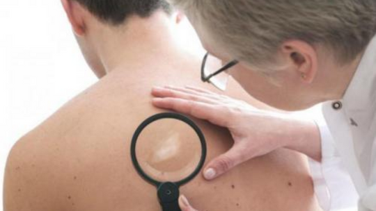 Manchas na pele sem sensibilidade pode ser hanseníase?