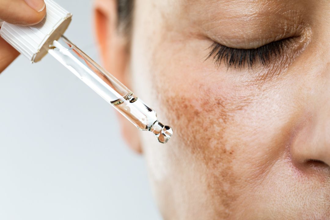 Tratamento de Melasma